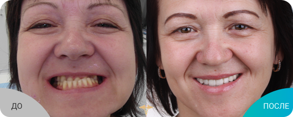 Восстановление верхнего и нижнего зубных рядов