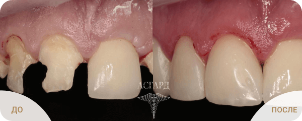Повреждение кариесом коронковой части передних зубов
