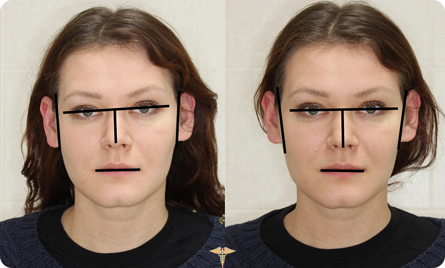 Генетика носа. Асимметрия лица. Коррекция асимметрии лица. Ассиметричное лицо. Несимметричное лицо.