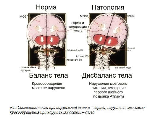 Лечение хронических нарушений мозгового кровообращения в Харькове
