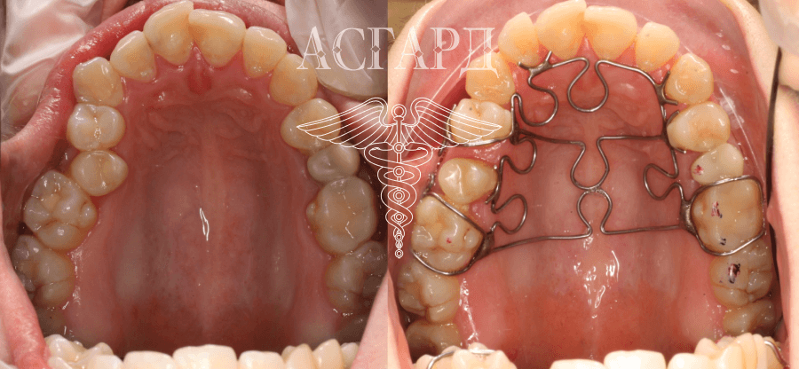Вспомогательные ортодонтические конструкции