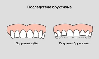 Повышенная стираемость зубов у взрослых и детей