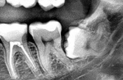 Зуб 8 корень. Ретинированный зуб мудрости рентген.