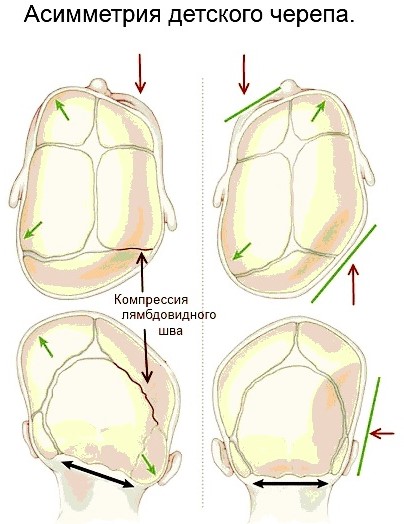 Деформация черепа у младенцев